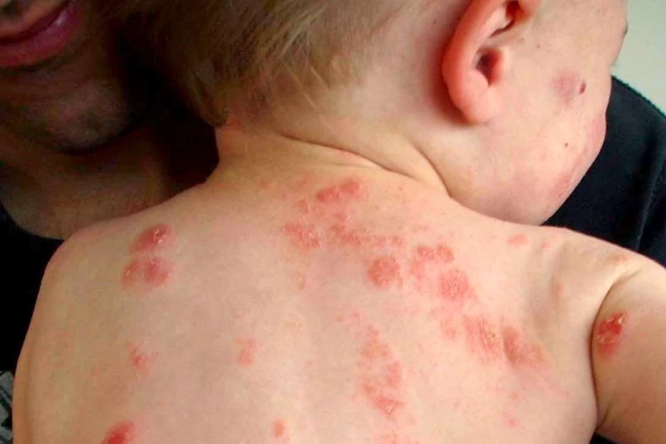 Σταφυλόκοκκος: Αυτά τα συμπτώματα θα σας «προειδοποιήσουν» αν έχετε μολυνθεί-Εικόνες